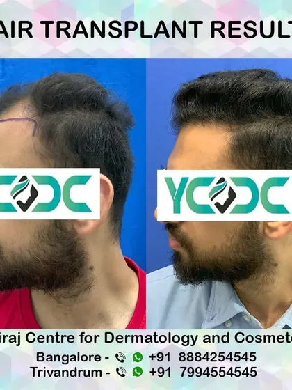 A profile view showing the pre-operative hairline design and the impressive final result, highlighting the artistry involved in hair restoration.