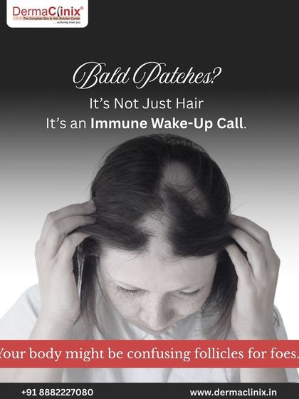 If you're seeing bald patches, it might be more than just hair loss. It could be an immune system issue like Alopecia Areata, where the body mistakenly attacks hair follicles.