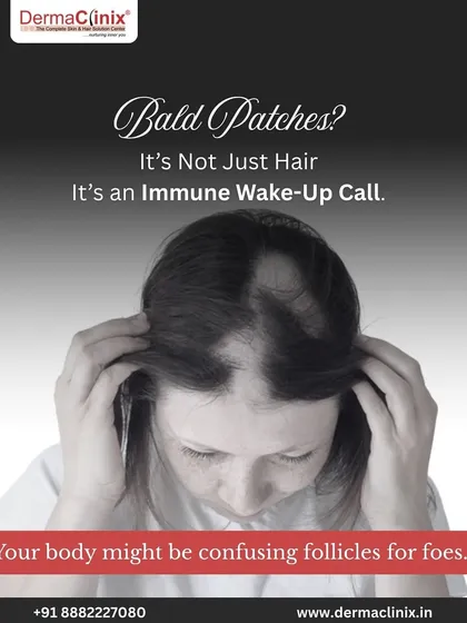 If you're seeing bald patches, it might be more than just hair loss. It could be an immune system issue like Alopecia Areata, where the body mistakenly attacks hair follicles.