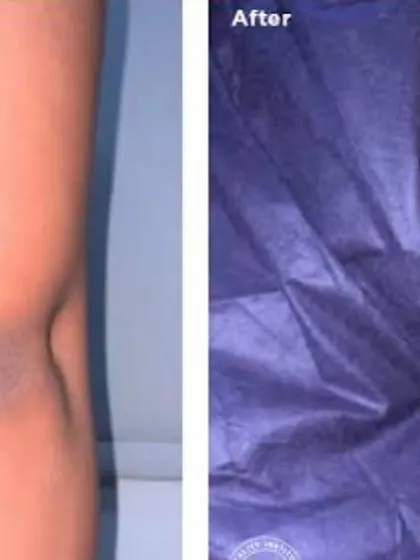 A clear before and after result of our crystal skin polishing treatment. Notice how the dark patch on the elbow area has significantly lightened, resulting in a more even skin tone.