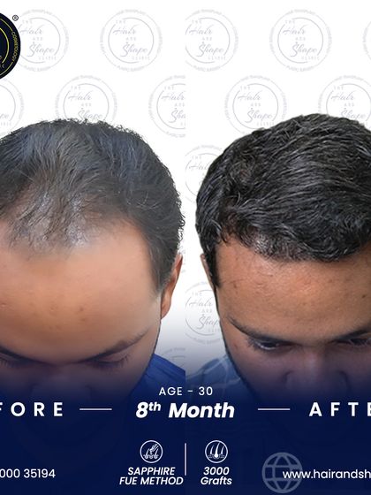 This top-down view demonstrates the successful restoration of density, covering the previously thinning areas for a uniform and healthy appearance.