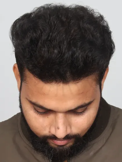 An incredible 8-month transformation for a Diffuse Grade 5A patient. With 4500 grafts, we recreated his hairline and restored the frontal and mid-scalp.