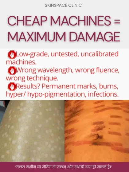 Using low-grade, uncalibrated machines with the wrong settings is a recipe for disaster. The images show permanent marks and burns that result from such practices. We invest in top-tier, calibrated technology to guarantee predictable and safe outcomes.