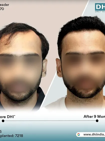 A before and after of a 26-year-old client 9 months post-procedure. With an impressive 7,218 hairs implanted, his hair is now incredibly dense and his hairline is perfectly restored.