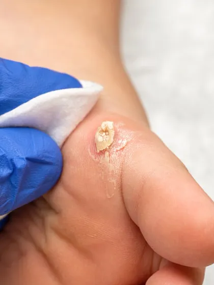 This image shows the treatment of a plantar wart, a common and often stubborn issue. I use clinically proven methods to effectively remove warts and address the underlying virus, providing a permanent solution that home remedies cannot offer.