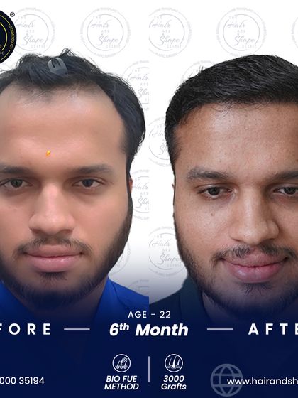 A frontal look at the 6-month progress. Early intervention with BIO FUE has given him a full, natural-looking head of hair.