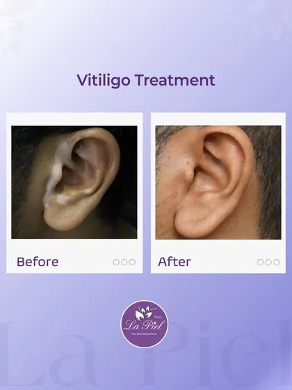 Treating vitiligo requires patience, expertise, and a deep understanding of the condition. This before-and-after result demonstrates the effectiveness of our vitiligo treatment protocol, which successfully helped restore pigmentation and achieve a more uniform skin tone for our patient.