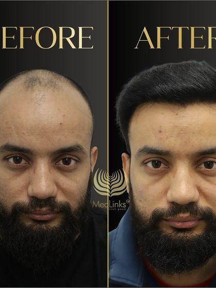 A powerful before and after transformation. We restored this patient's hair from a state of advanced baldness to a full, natural-looking head of hair.