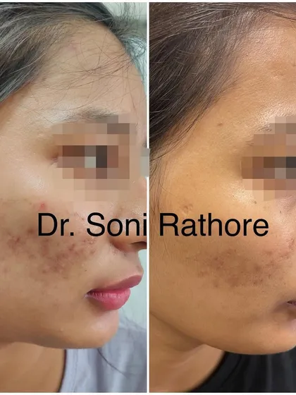 Even just two weeks into treatment, you can see the skin beginning to calm down. This early progress is very encouraging and shows the importance of combining professional treatment with diet and lifestyle changes.