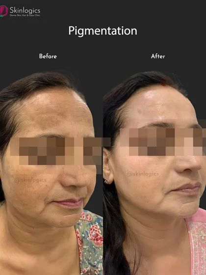 A side-profile view of the same patient as image 15, this photo provides another angle of the successful pigmentation treatment. It highlights the clearing of dark patches along the cheek and temple area.
