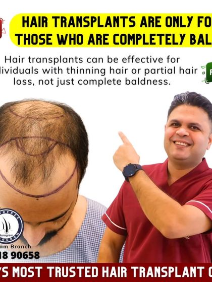 Myth: Transplants are only for the completely bald. Fact: Not at all. Transplants are very effective for people with thinning hair or partial hair loss to add density and redefine the hairline. Early action often gives the best results.