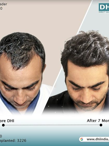 A top-down view of the same client's 7-month progress. This image clearly shows the new growth and increased density, highlighting the impressive results of his DHI hair transplant.