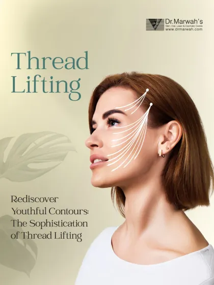 This image explains the principle of a thread lift, a minimally invasive technique I use for a subtle, natural-looking lift. The procedure involves placing biocompatible threads to create a supportive scaffold under the skin, repositioning tissue and stimulating long-term collagen production.
