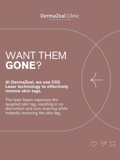 Want them gone? At my clinic, I use CO2 Laser technology to effectively remove skin tags. The laser beam vaporizes the tag instantly with no discomfort and zero scarring.