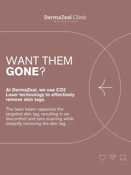 Want them gone? At my clinic, I use CO2 Laser technology to effectively remove skin tags. The laser beam vaporizes the tag instantly with no discomfort and zero scarring.