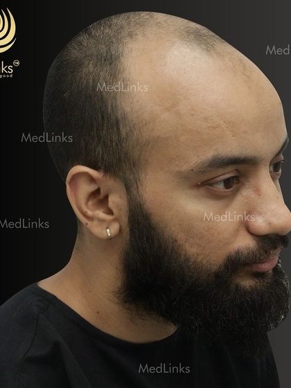 The patient before the procedure, showing complete baldness on the top of his scalp.