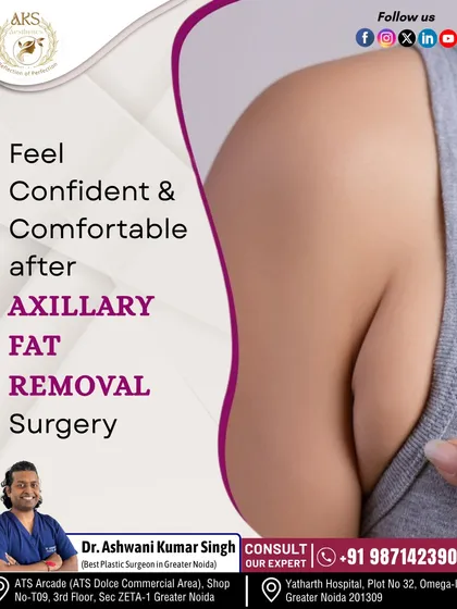 The small bulge of fat in the underarm area, known as axillary fat, can be a concern for many. I perform axillary fat removal to create a smoother, more streamlined contour between the breast and arm, helping you feel more confident in sleeveless clothing.