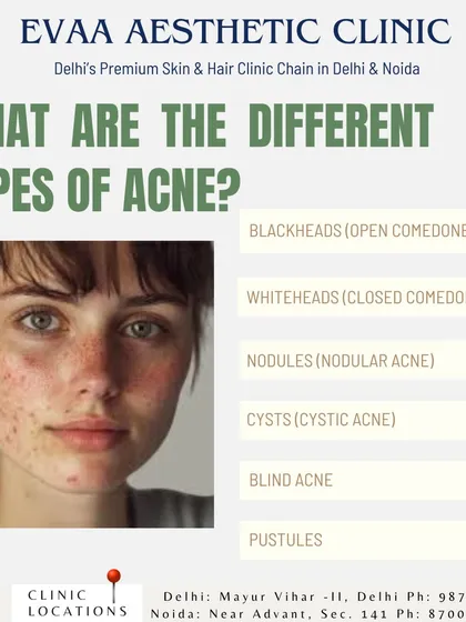 An educational graphic identifying the different types of acne we treat, from common blackheads and whiteheads to more severe forms like nodular and cystic acne.