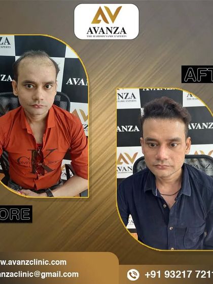 A dramatic change in appearance. This client's hair transplant has restored his hairline and given him a much more youthful and confident look.