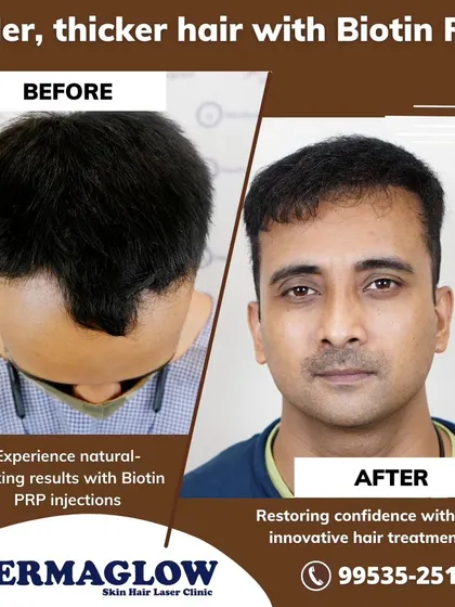 This before-and-after image demonstrates the effectiveness of our non-surgical Biotin PRP therapy. The treatment successfully addressed the client's receding hairline and thinning on top, resulting in visibly fuller and thicker hair.
