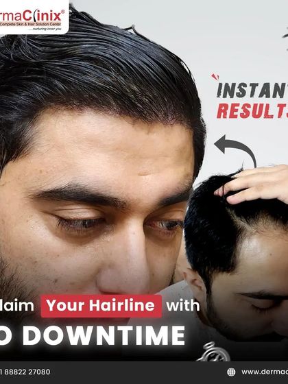 Reclaim your hairline with no downtime. This image shows the instant, visible results of a Long Hair FUE transplant, where hair is restored without any shaving or trimming.