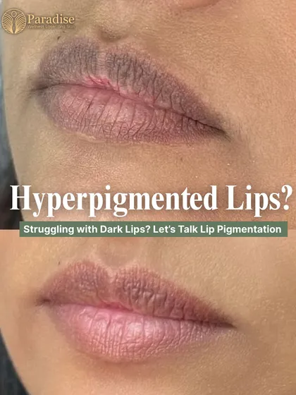 Dark or pigmented lips can be a common concern, and this before and after demonstrates a real transformation. Using a specialized Carbon Laser Peel for lips, I can safely lighten pigmentation and restore the natural, even tone of your lips over a few sessions.
