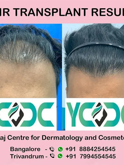 This image showcases the frontal view of a hair transplant, emphasizing the new, lower, and denser hairline that frames the patient's face effectively.
