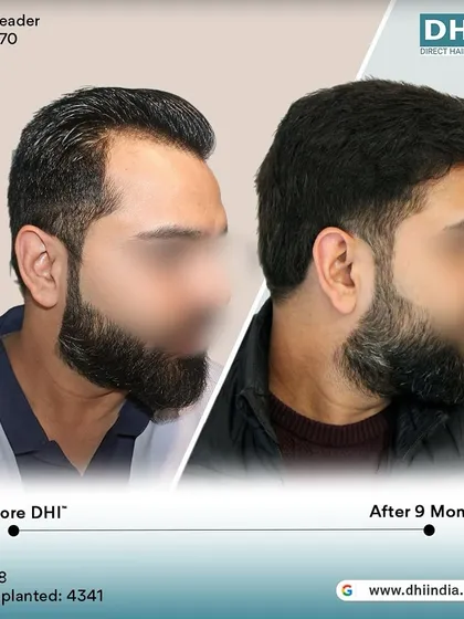 Another side-profile view of the 9-month result. The client's full head of hair and confident appearance speak volumes about the success and satisfaction delivered by his DHI procedure.