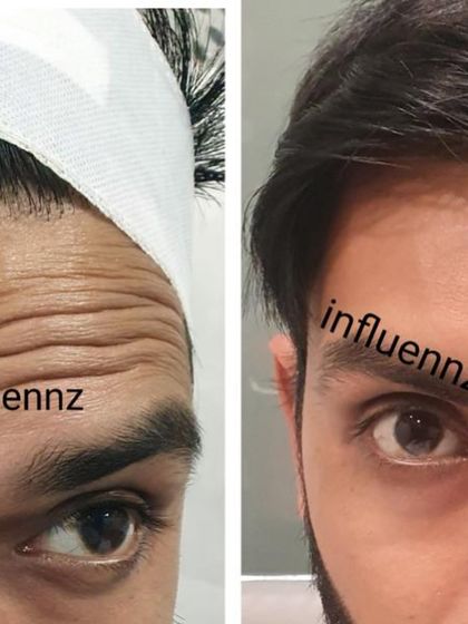 This before and after of a male patient demonstrates the effectiveness of Botox in reducing deep forehead wrinkles for a refreshed appearance.