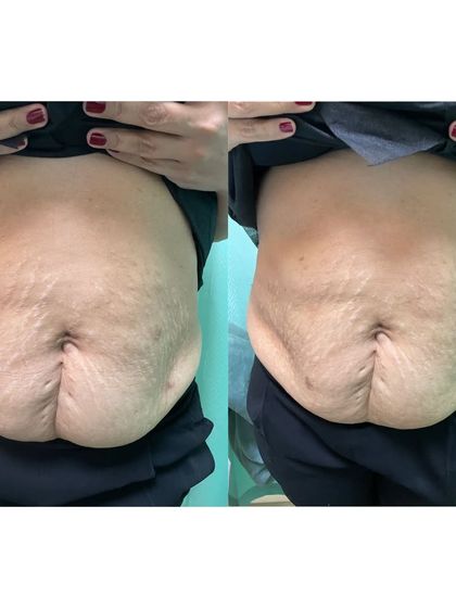 A before and after shot of an abdominal skin tightening session. Our treatments help improve skin elasticity and texture post-pregnancy or weight loss.
