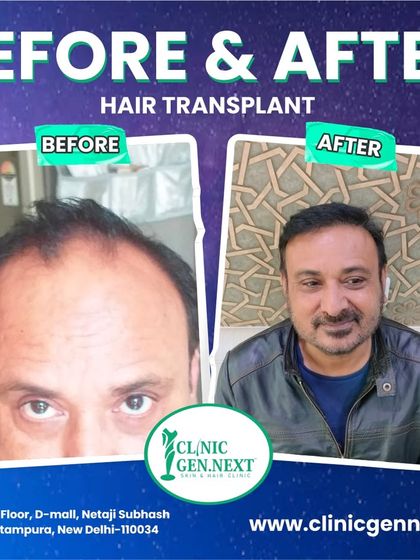 This before-and-after shot shows a happy patient with his final, natural-looking result, a significant change from his previous hair loss.