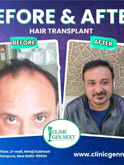 This before-and-after shot shows a happy patient with his final, natural-looking result, a significant change from his previous hair loss.