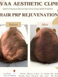 Hair Restoration