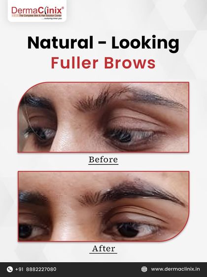 This before and after image shows the result of an eyebrow transplant. The procedure creates thicker, fuller, and natural looking brows, permanently enhancing facial features.