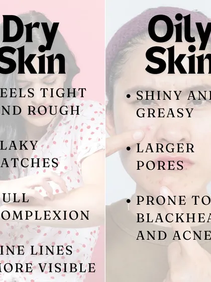 A simple comparison: dry skin often feels tight and rough with a dull complexion, while oily skin is shiny with larger pores and is prone to blackheads.