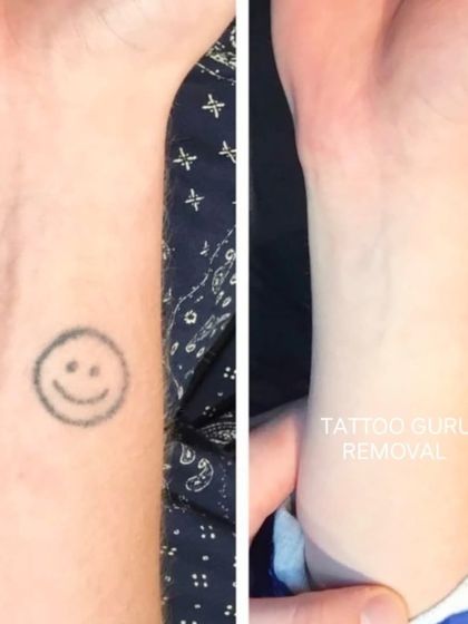 A simple smiley face outline tattoo on the wrist, completely gone after treatment. This shows that even older, faded tattoos can be fully removed.