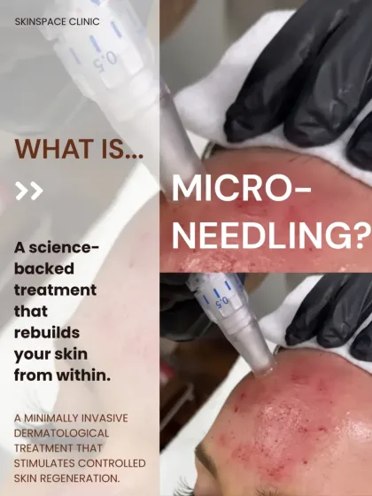 Microneedling is a core treatment for skin regeneration. It's a science-backed procedure that stimulates your skin's natural repair process to reduce scars, refine texture, and build new collagen from within.
