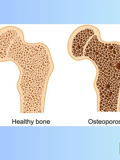 A visual comparison between a healthy bone and a bone affected by osteoporosis. This shows the loss of density that makes bones fragile.