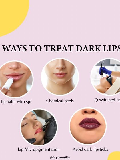 Dark lips can be caused by genetics or sun exposure, but there are effective ways to treat them. My approach includes recommending lip balms with SPF, performing in-clinic chemical peels or Q-switched laser sessions, and in some cases, using lip micropigmentation for a temporary color enhancement.
