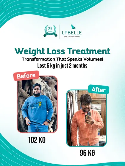 A transformation that speaks for itself. This client achieved a 6 kg weight loss in just two months, showcasing the effectiveness of our tailored weight loss treatments for men.