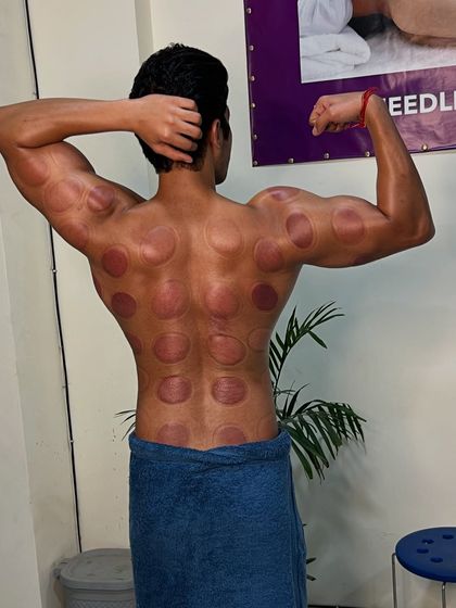 Another angle of Sumit's back post-cupping.