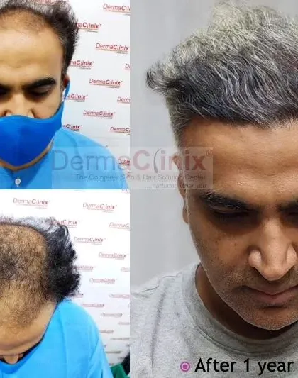 A side-by-side comparison showing the baseline hair loss and the result one year after surgery. This patient's transformation highlights the effectiveness of the FUE transplant in restoring a youthful and full head of hair.