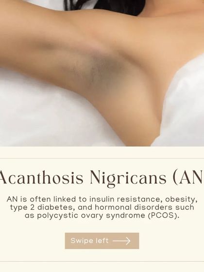 Darkening of the skin in areas like the underarms, known as Acanthosis Nigricans, is often linked to internal health conditions like insulin resistance and PCOS. We help you understand the cause.