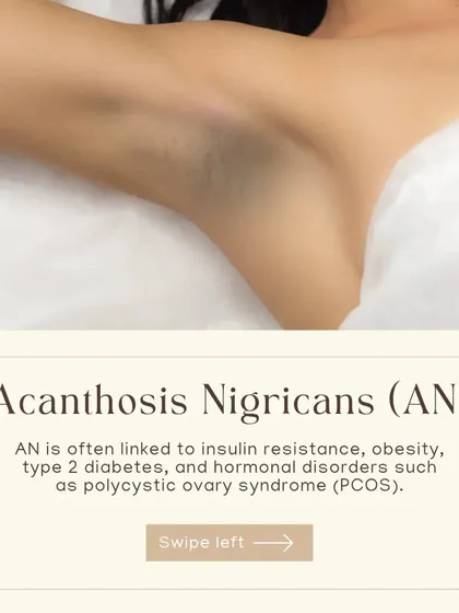 A condition called Acanthosis Nigricans (AN) can cause dark, velvety patches. It is often linked to insulin resistance, obesity, and hormonal disorders like Polycystic Ovary Syndrome (PCOS).