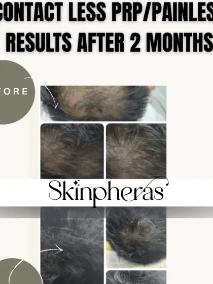We are proud to be one of the only clinics in Gurgaon offering Contactless PRP with JetPeel technology. This before-and-after image shows significant hair regrowth after just two months, achieved without any needles or pain.