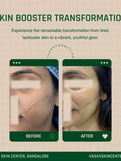 This before and after shows the result of a Skin Booster treatment. The 'after' image displays visibly improved skin hydration, a reduction in dullness, and an overall youthful glow, demonstrating how these treatments rejuvenate the skin from within.
