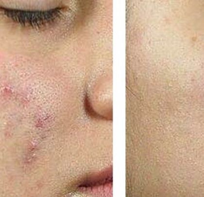 This before-and-after shows a significant improvement in skin clarity and texture. I use a combination of treatments to tackle both the acne bacteria and the resulting surface irregularities.