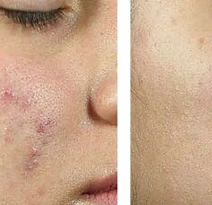 This before-and-after shows a significant improvement in skin clarity and texture. I use a combination of treatments to tackle both the acne bacteria and the resulting surface irregularities.