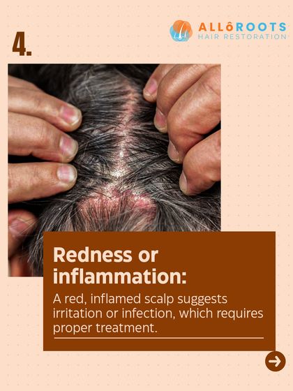 Redness or inflammation on the scalp suggests irritation or a possible infection. This requires proper medical treatment to calm the inflammation and restore scalp health.