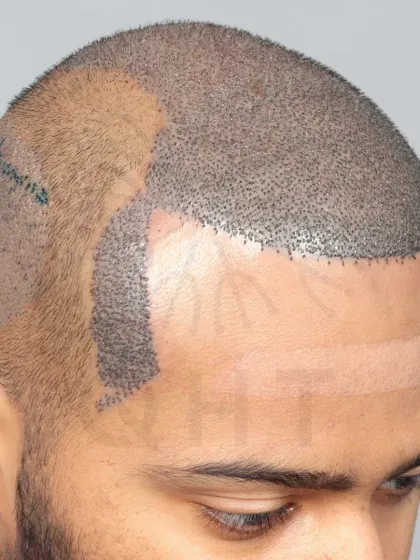 A Norwood Grade 6 transformation in progress. 5900 grafts were placed to recreate the hairline, frontal part, mid-scalp, crown, and temples.